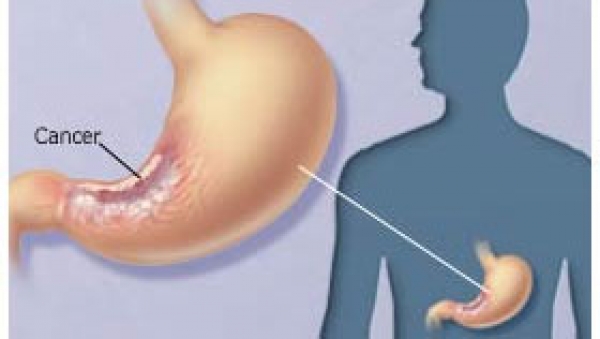 تغذیه و پیشگیری از سرطان معده